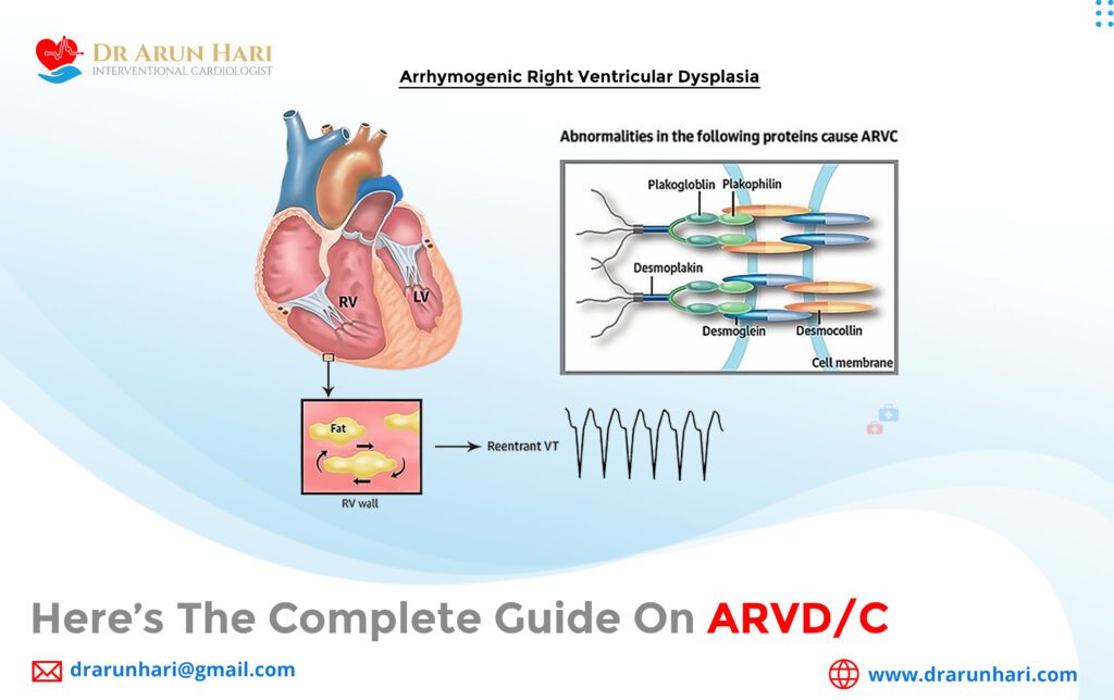 Here’s the Complete Guide on ARVD/C