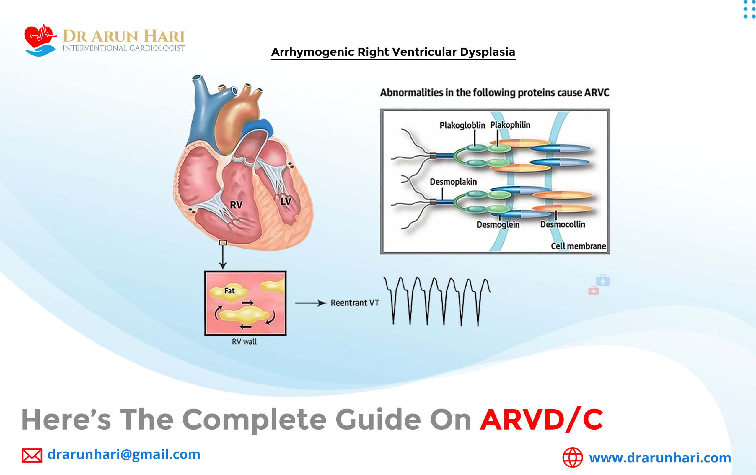 You are currently viewing Here’s the Complete Guide on ARVD/C