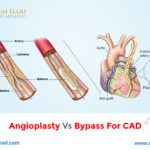 Angioplasty Vs Bypass for CAD