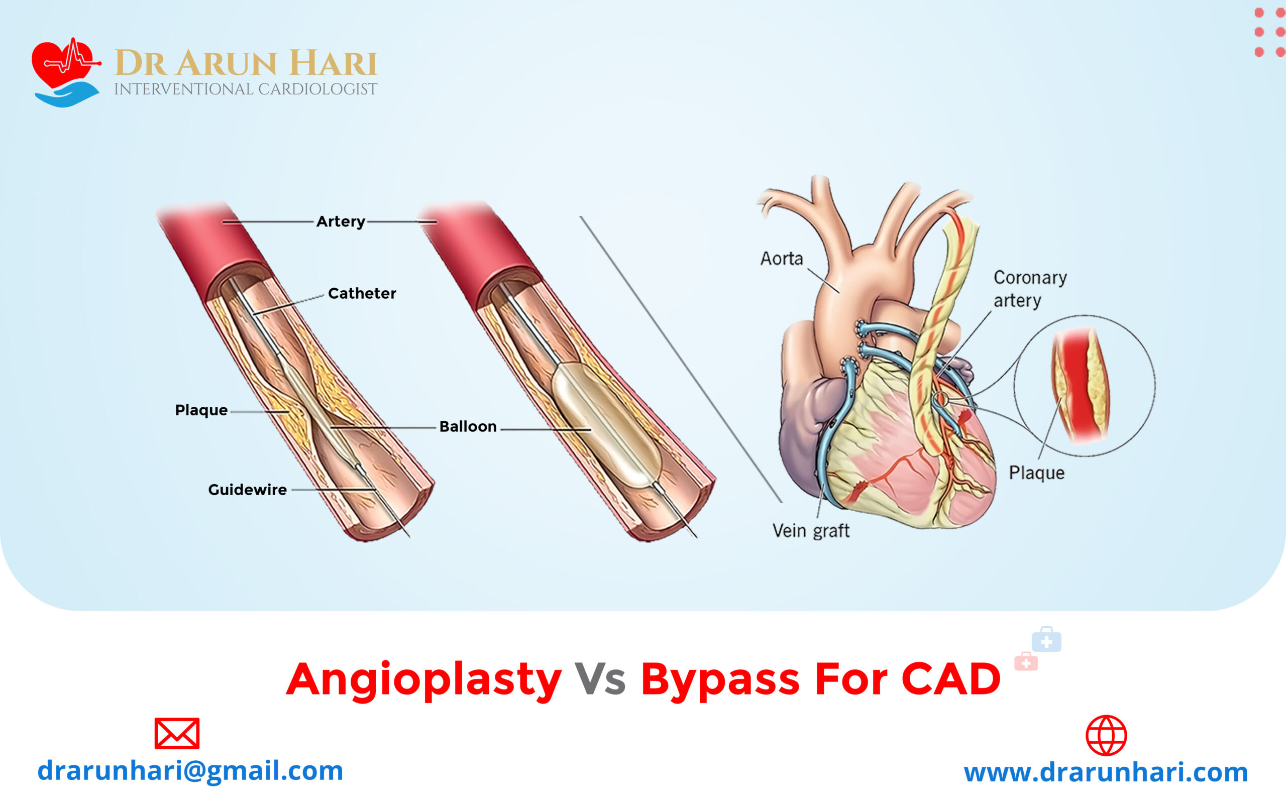 Read more about the article Angioplasty Vs Bypass for CAD