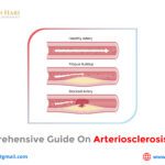 A Comprehensive Guide on Arteriosclerosis