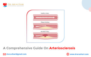 Read more about the article A Comprehensive Guide on Arteriosclerosis