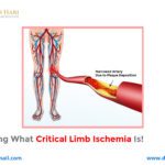 Explicating What Critical Limb Ischemia Is!