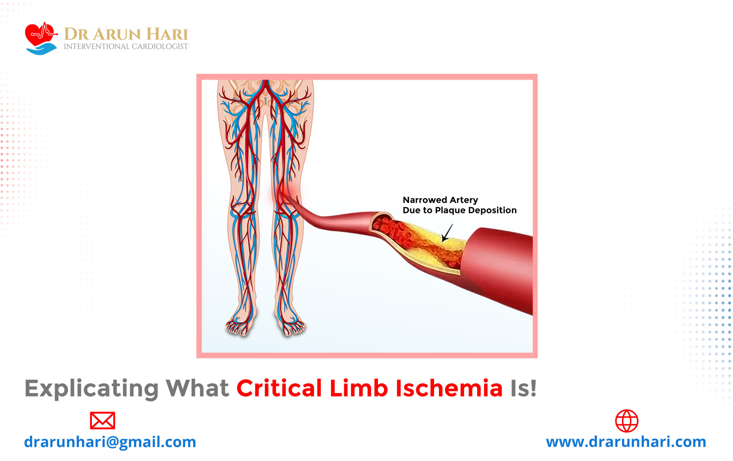 Read more about the article Explicating What Critical Limb Ischemia Is!