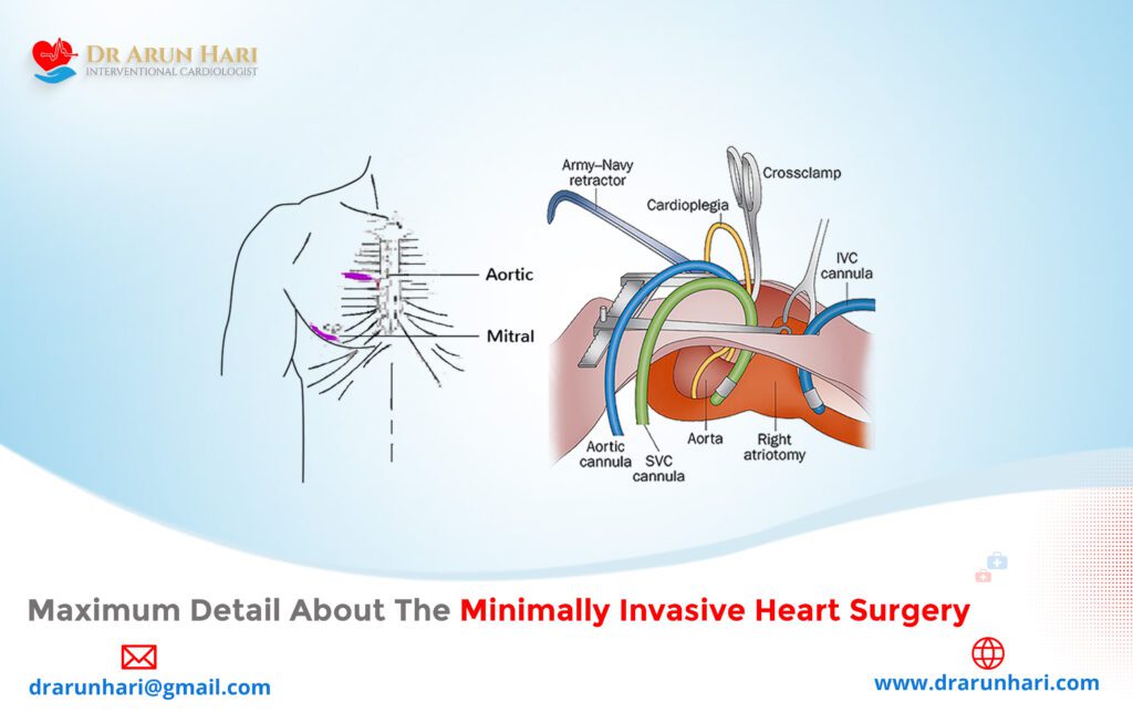 Maximum Detail About The Minimally Invasive Heart Surgery - Dr Arun Hari