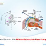 Maximum Detail about the Minimally Invasive Heart Surgery