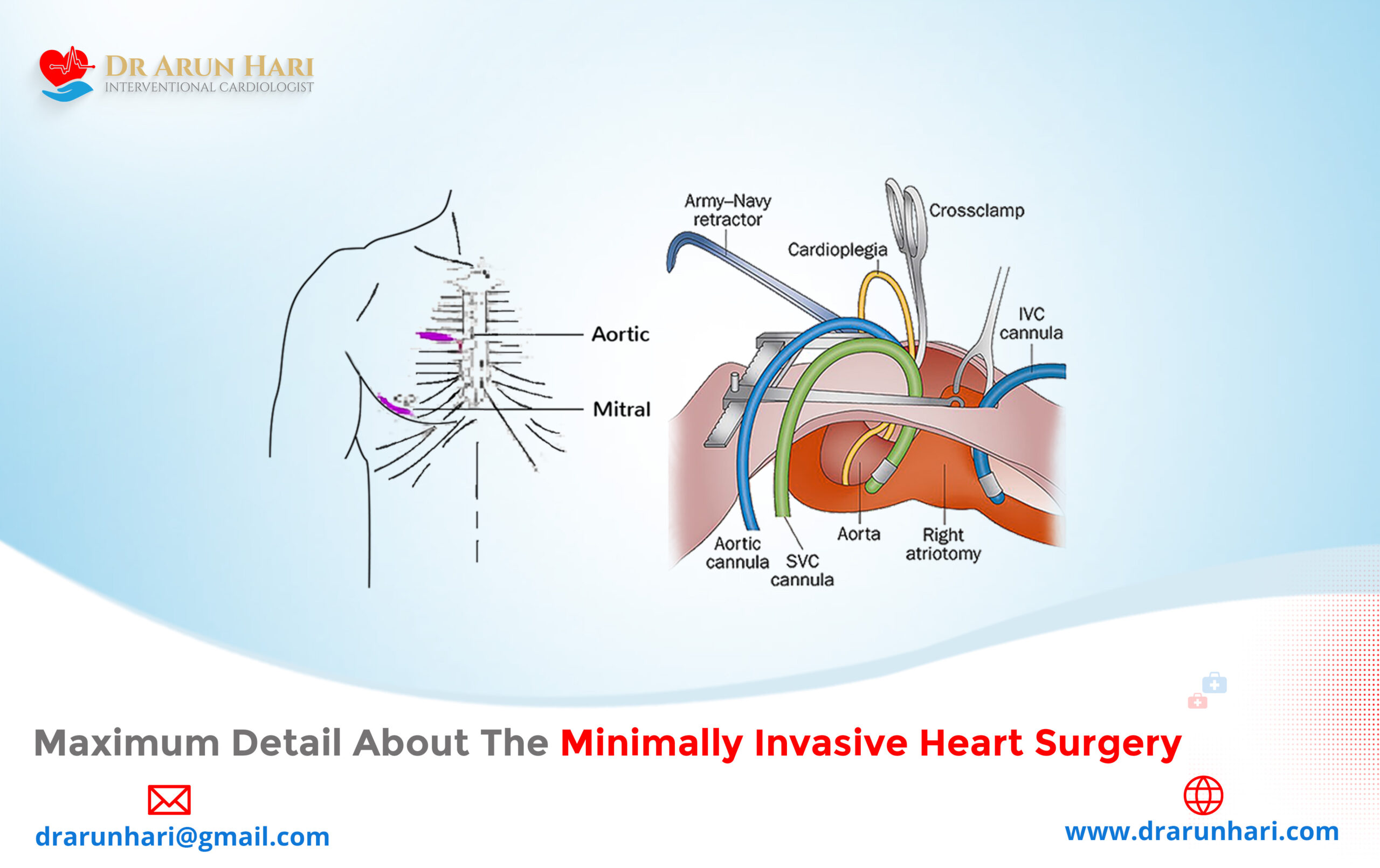 Read more about the article Maximum Detail about the Minimally Invasive Heart Surgery