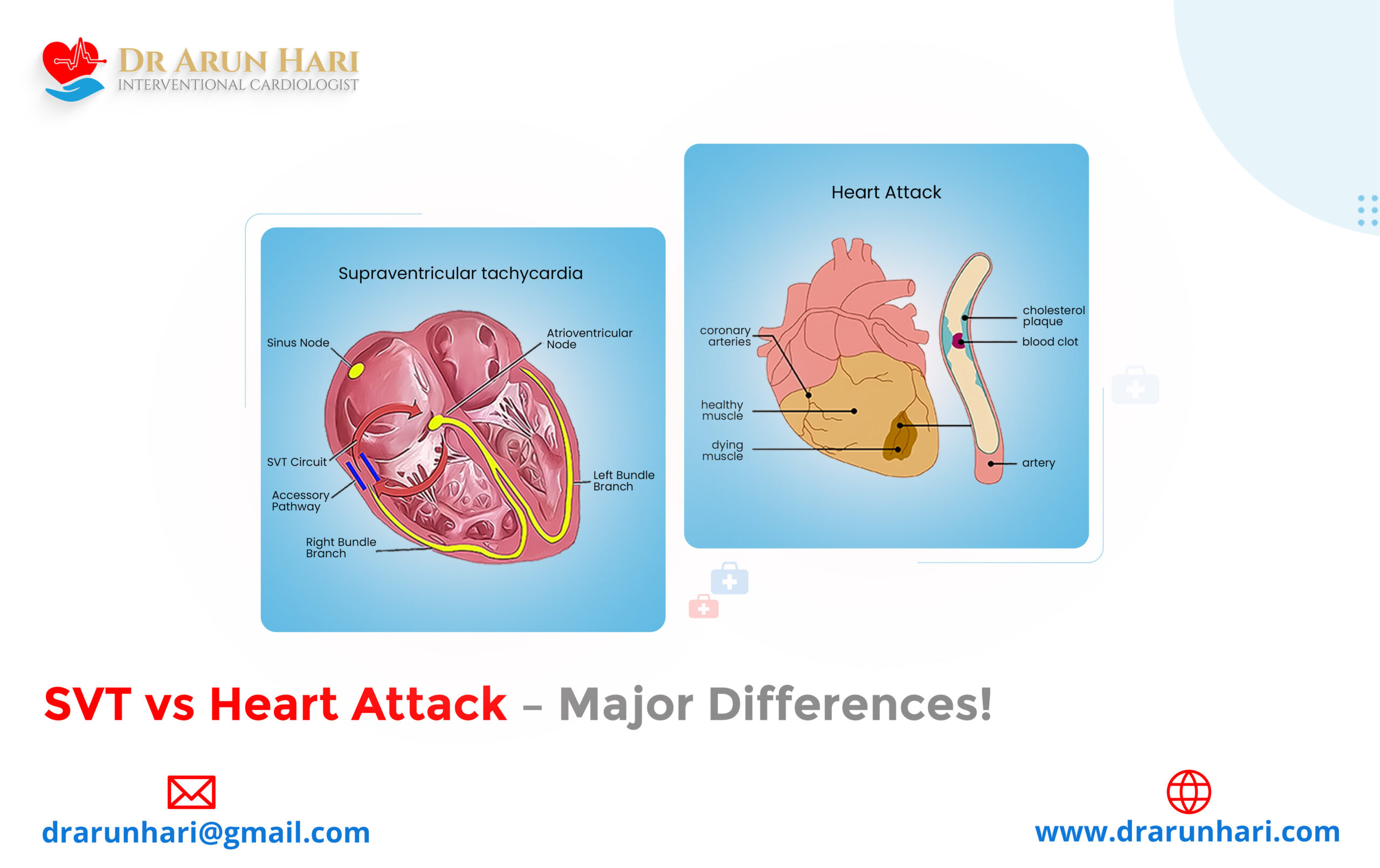 Read more about the article SVT vs Heart Attack – Major Differences!