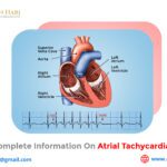 Collect Complete Information on Atrial Tachycardia