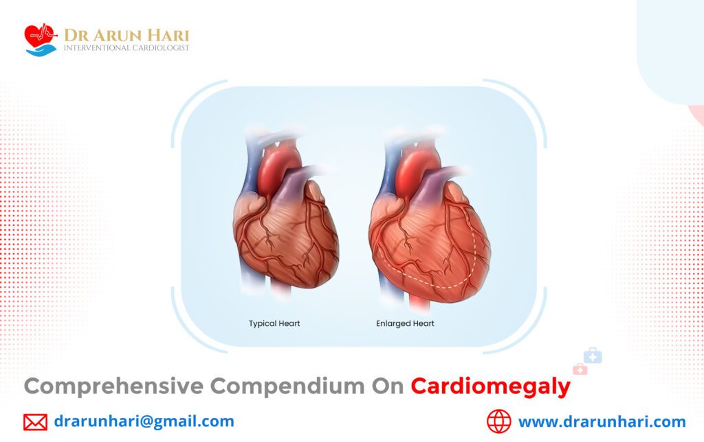 Comprehensive Compendium On Cardiomegaly - Dr Arun Hari