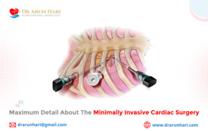 Read more about the article Maximum Detail about the Minimally Invasive Cardiac Surgery