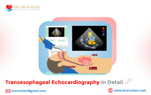 Read more about the article Transesophageal Echocardiography in Detail