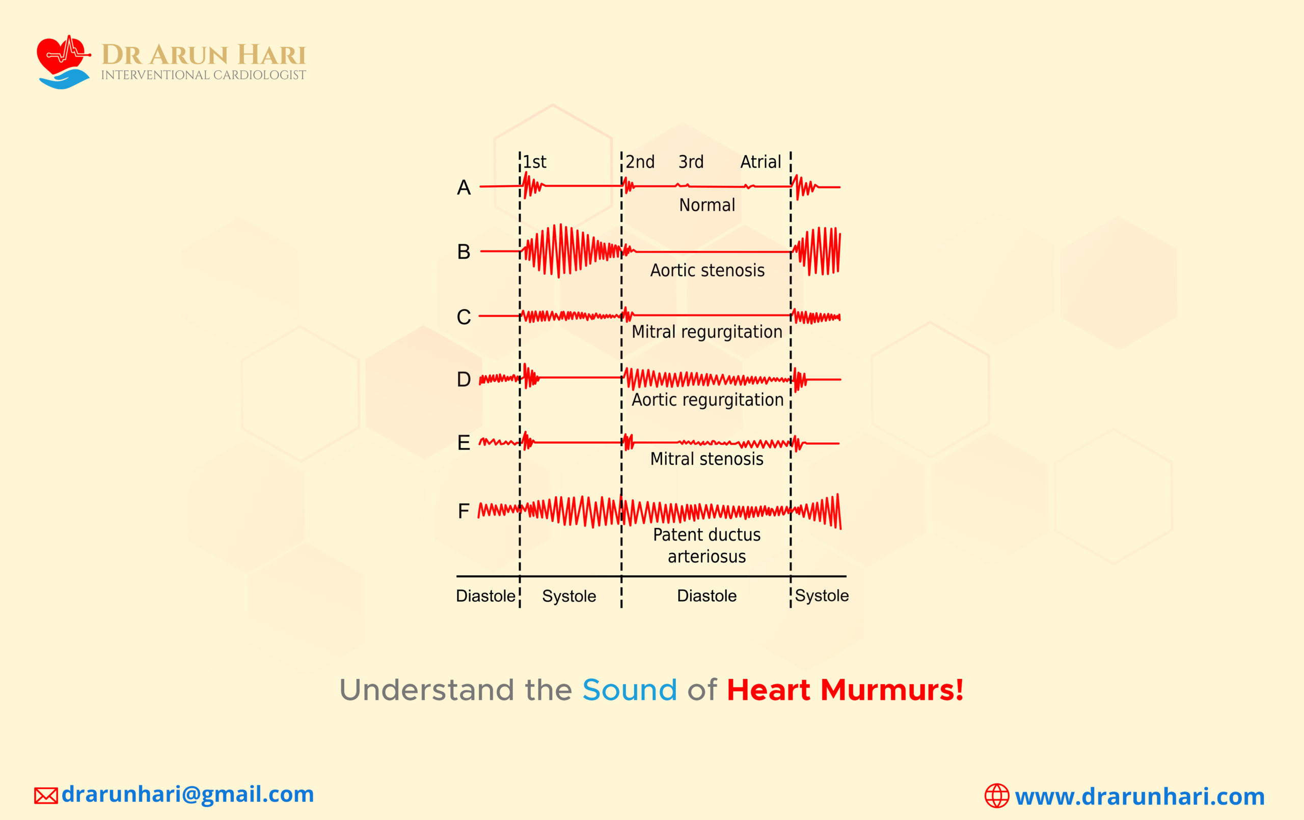 Read more about the article Understand the Sound of Heart Murmurs!