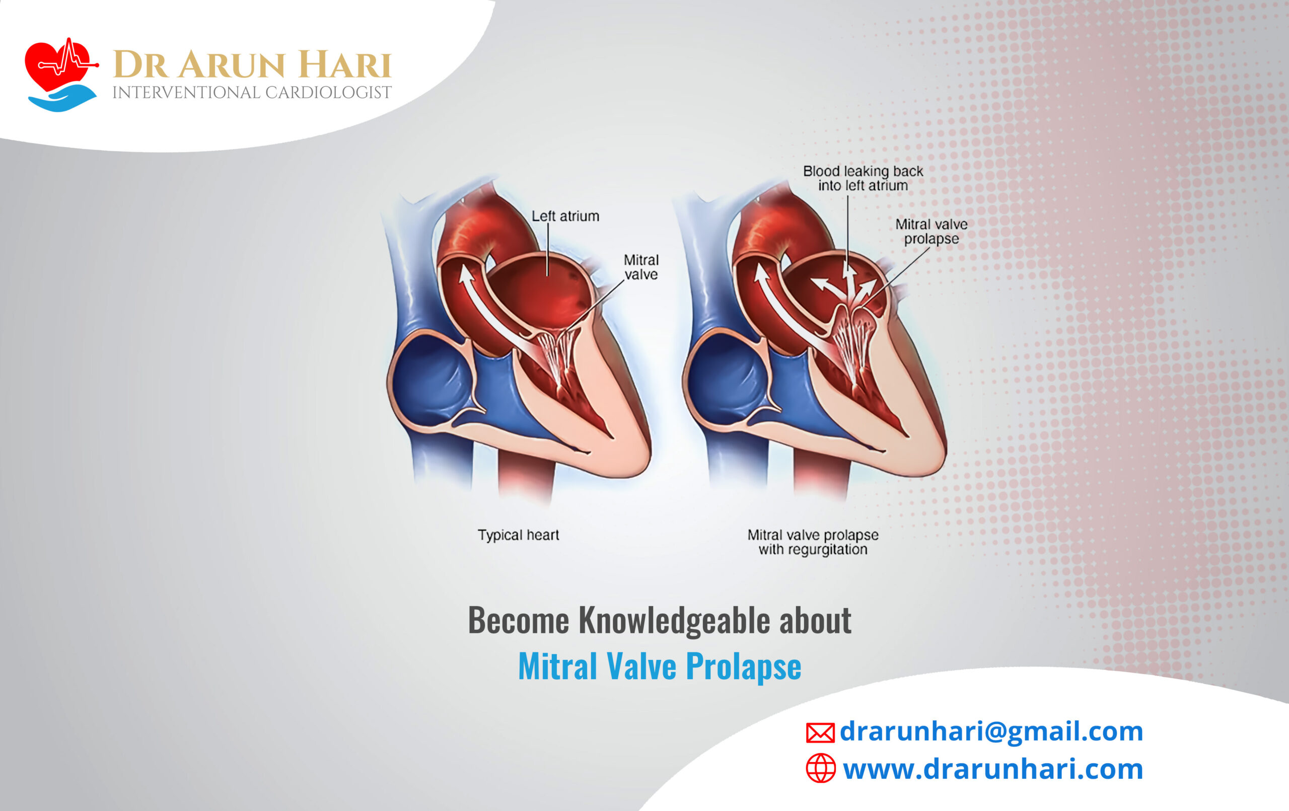 Read more about the article Become Knowledgeable about Mitral Valve Prolapse