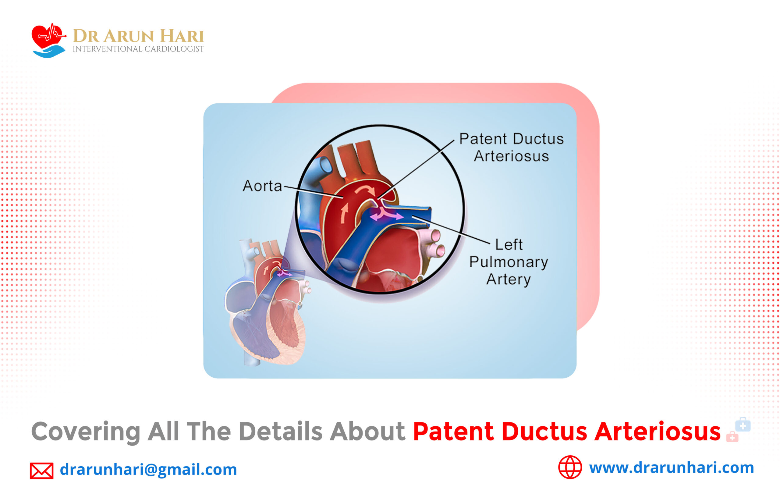 Covering All the Details about Patent Ductus Arteriosus