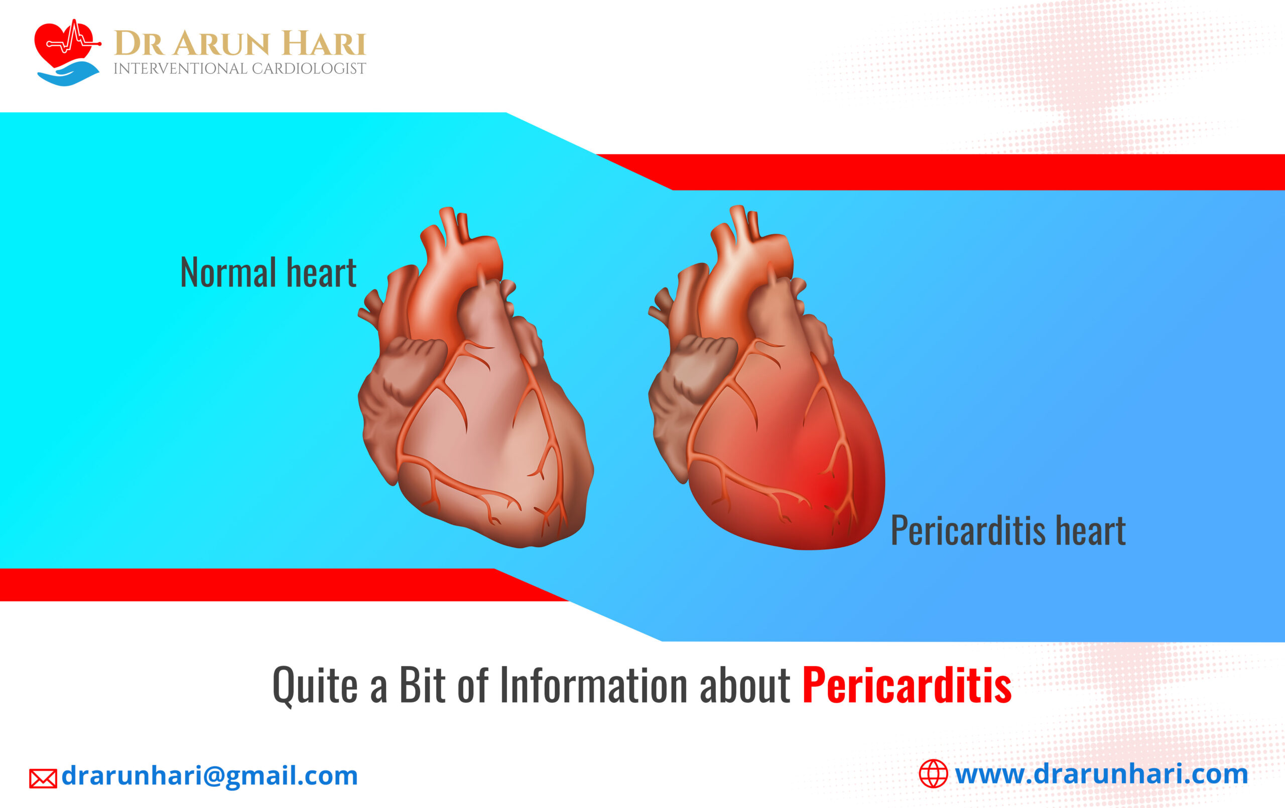 Read more about the article Quite a Bit of Information about Pericarditis