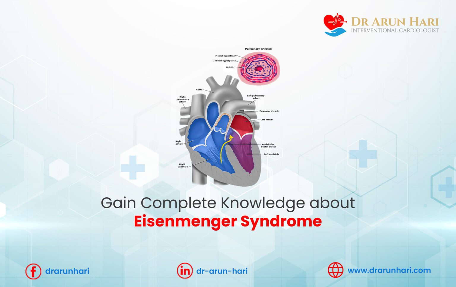 Gain Complete Knowledge about Eisenmenger Syndrome - Dr Arun Hari