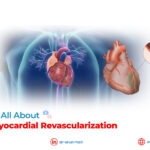 Know It All about Transmyocardial Revascularization