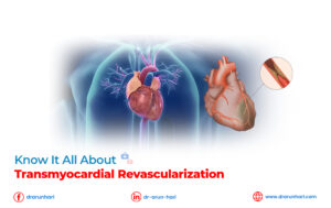Read more about the article Know It All about Transmyocardial Revascularization