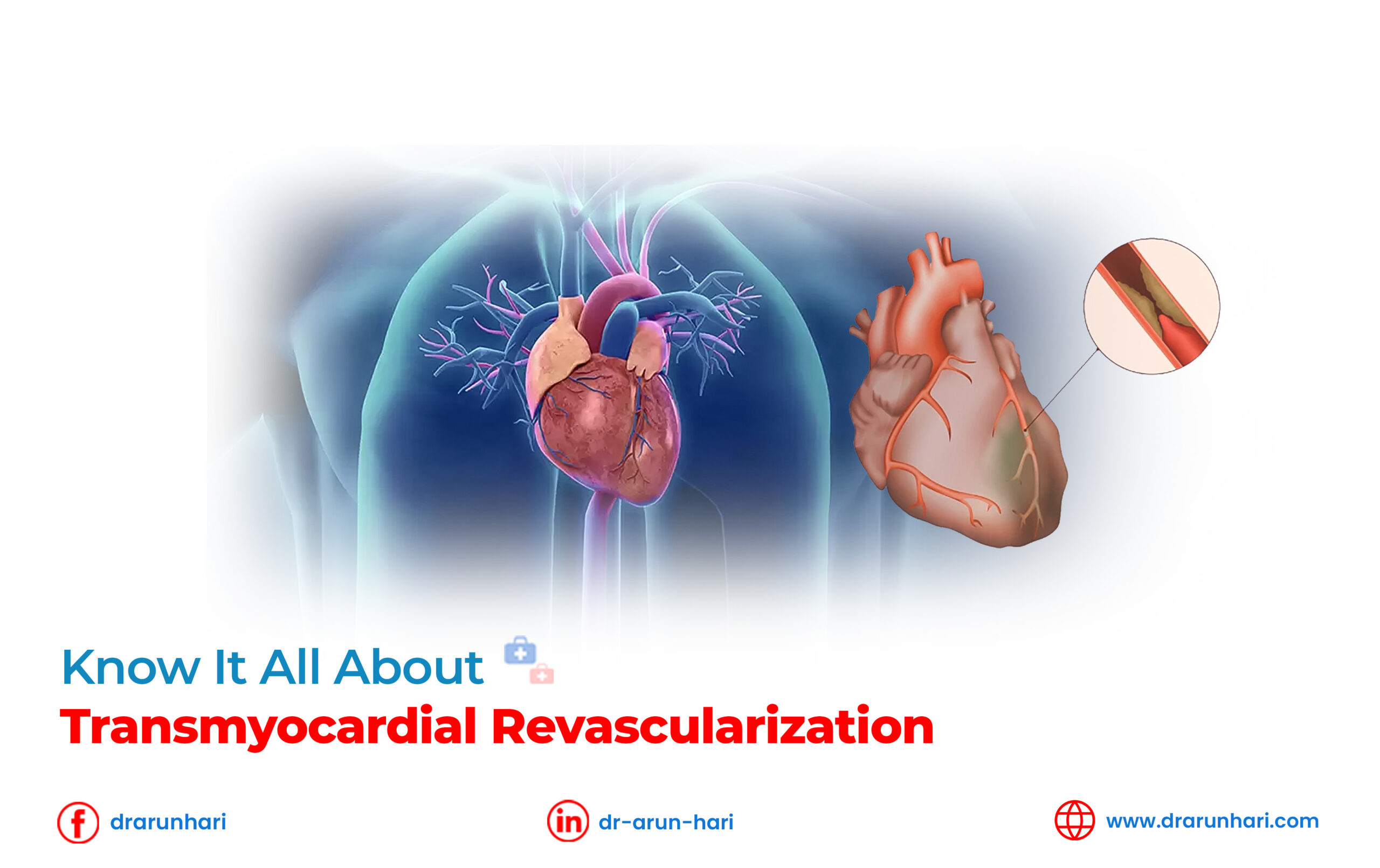 Read more about the article Know It All about Transmyocardial Revascularization