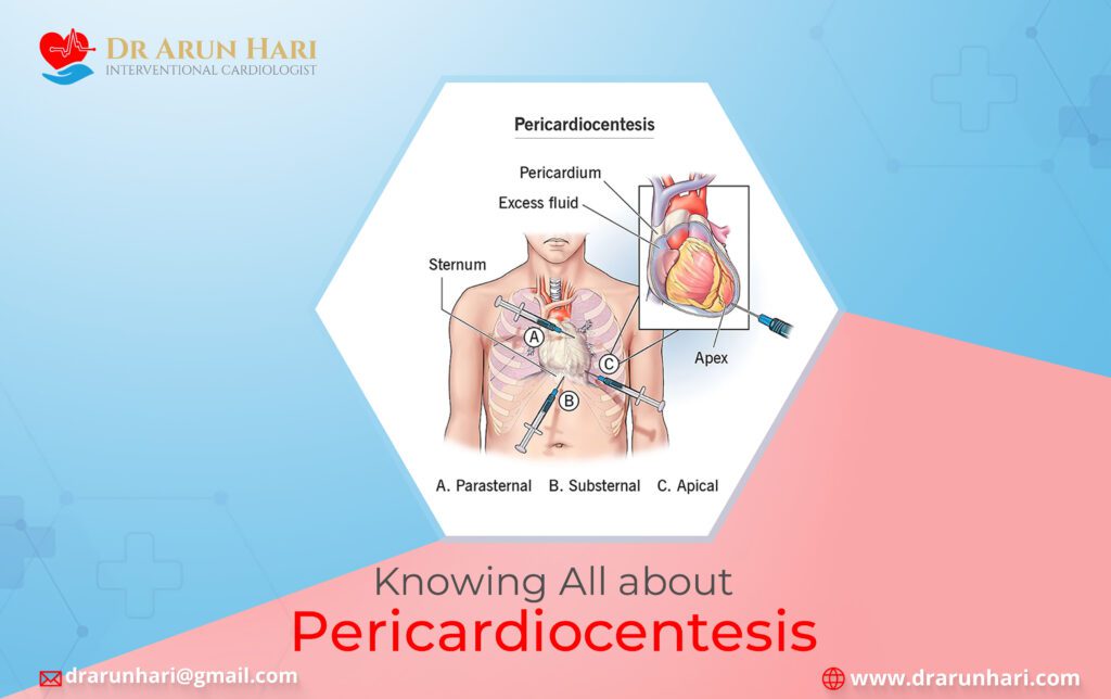 पेरीकार्डियोसेंटेसिस के बारे में सब कुछ जानिए