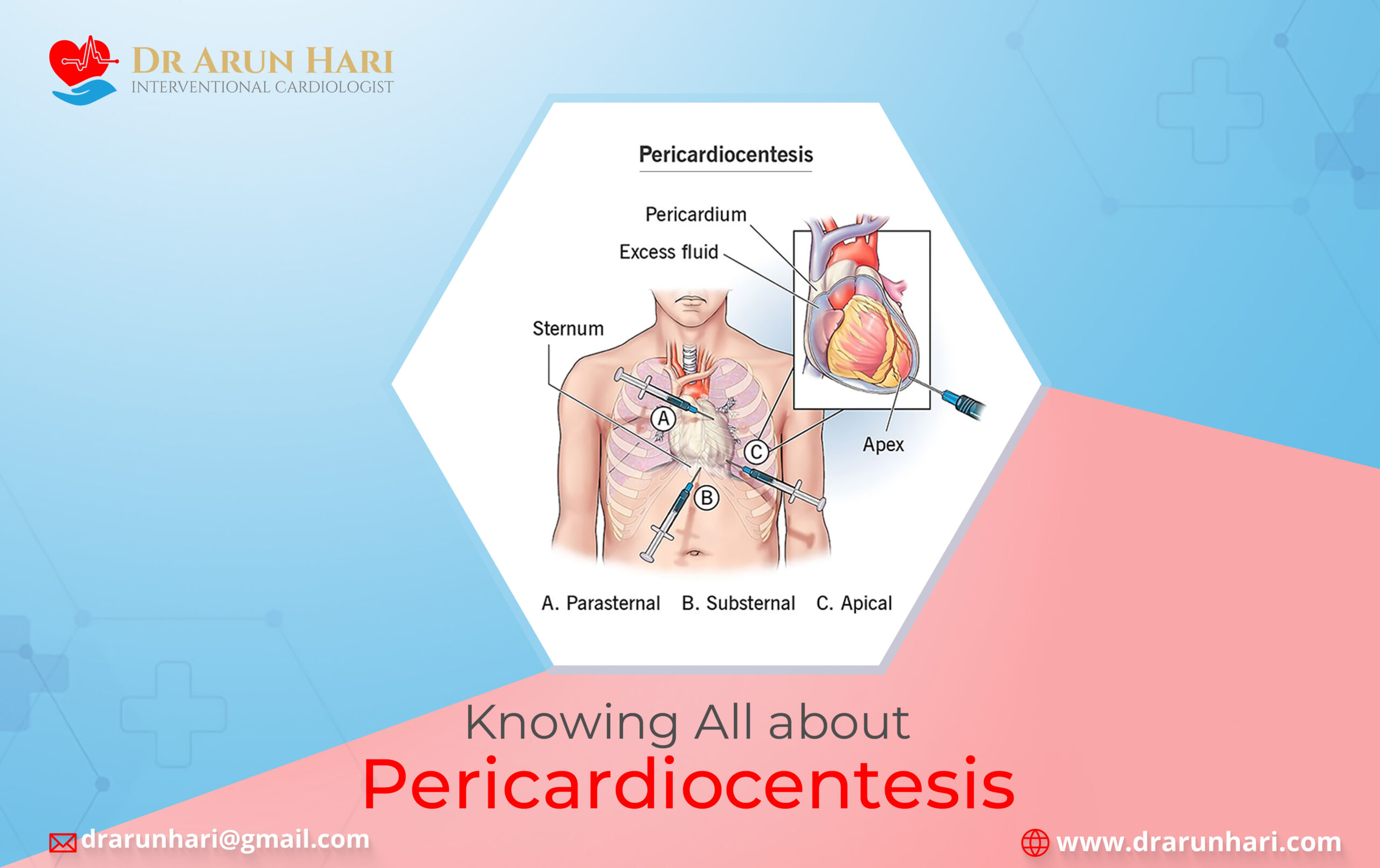 Read more about the article पेरीकार्डियोसेंटेसिस के बारे में सब कुछ जानिए