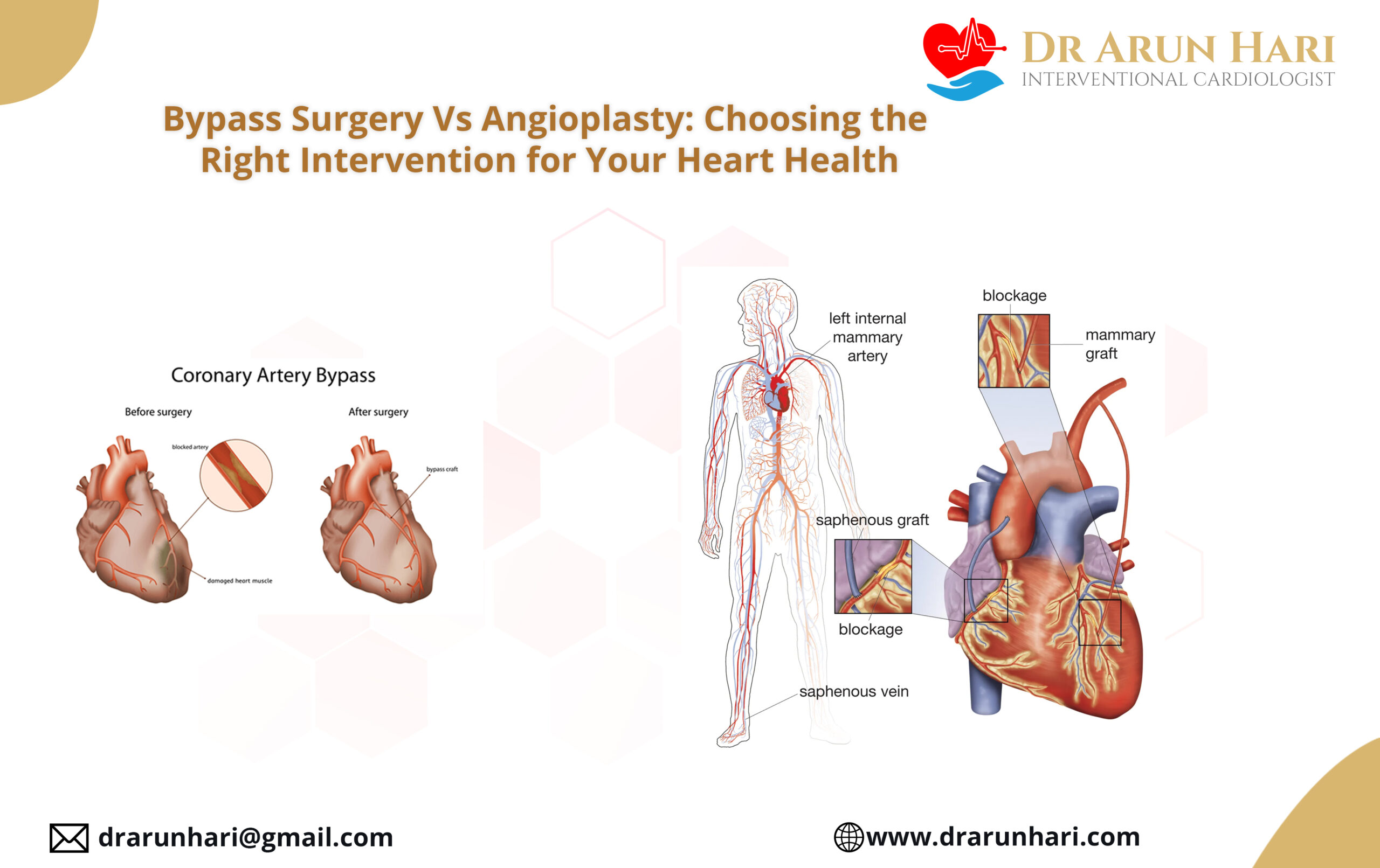 Read more about the article Bypass Surgery Vs Angioplasty: Choosing the Right Intervention for Your Heart Health