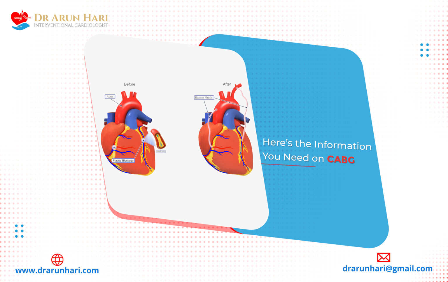 Read more about the article Here’s the Information You Need on CABG