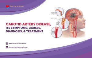 Read more about the article Carotid Artery Disease, Its Symptoms, Causes, Diagnosis, & Treatment!