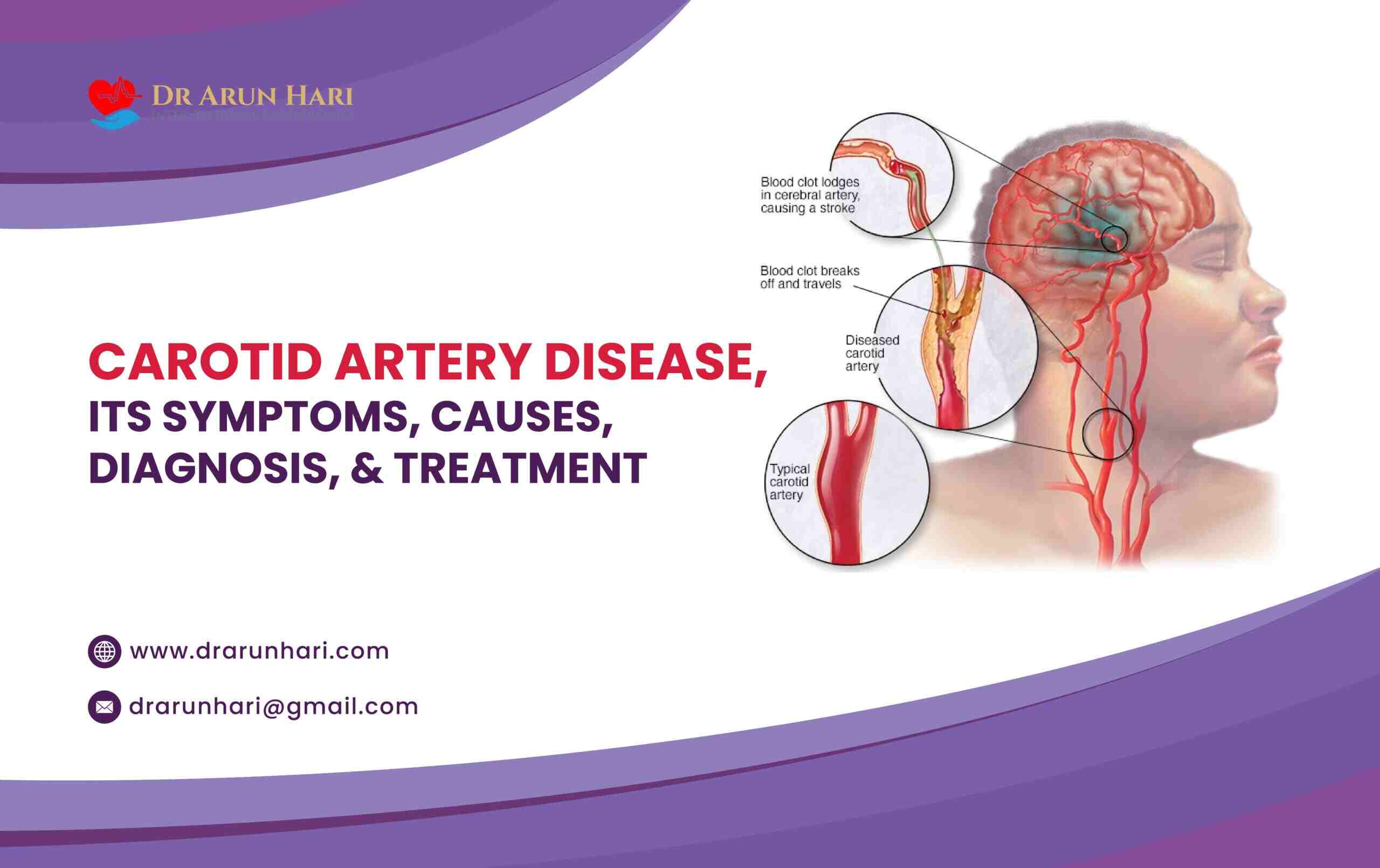 You are currently viewing Carotid Artery Disease, Its Symptoms, Causes, Diagnosis, & Treatment!