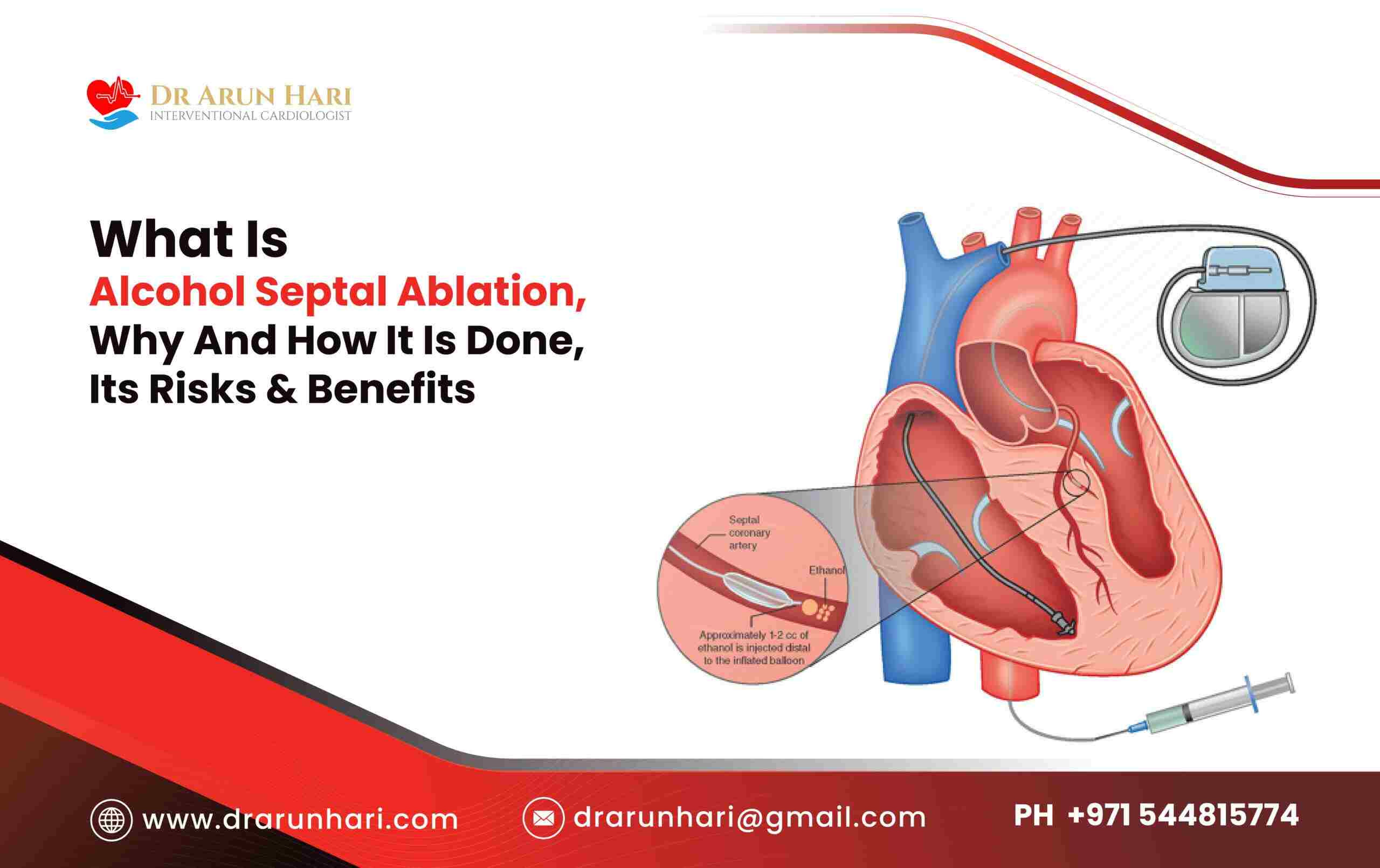 You are currently viewing Alcohol Septal Ablation – Why & How It’s Done, Its Risks & Benefits