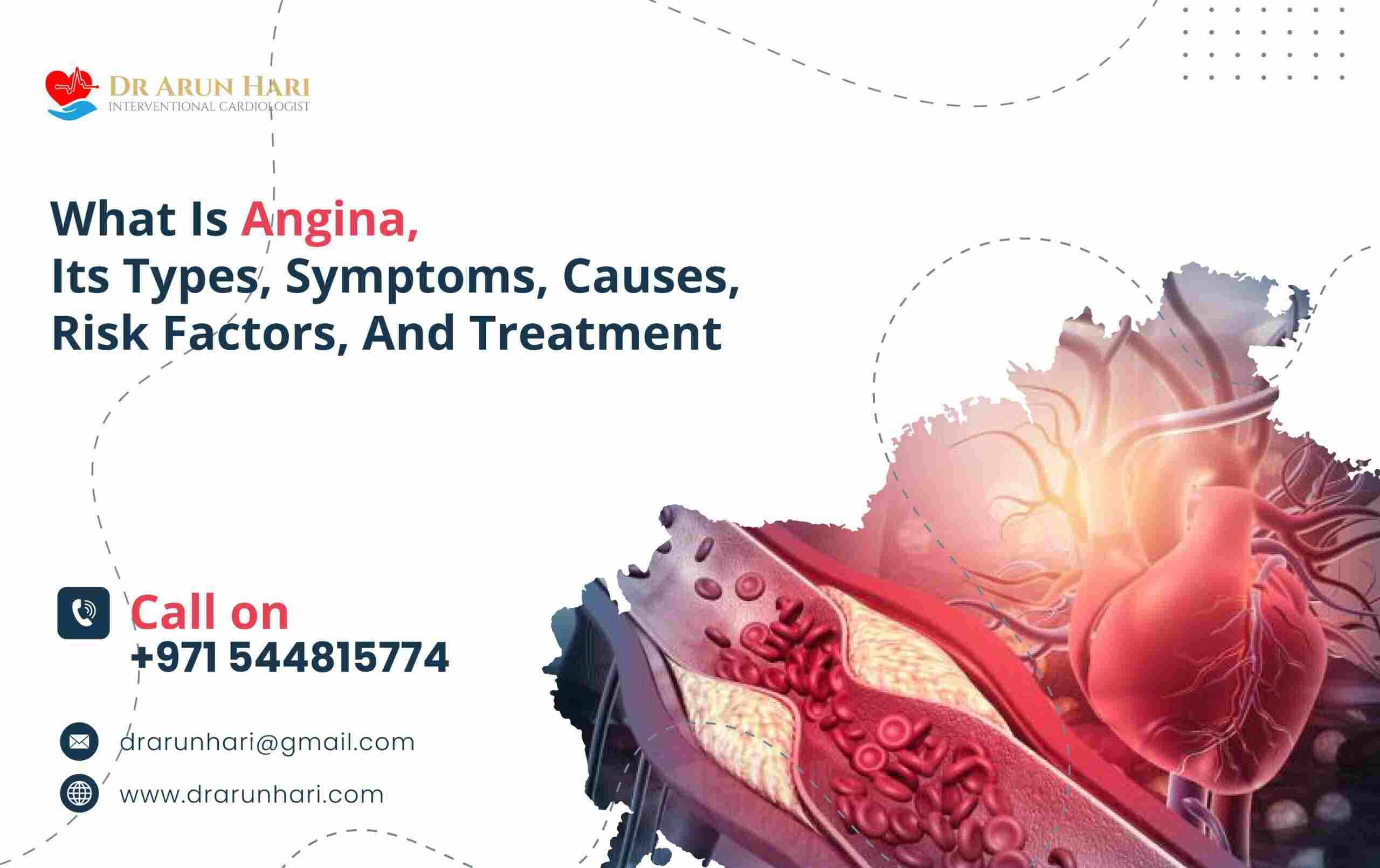 You are currently viewing Angina: Types, Symptoms, Causes, Risks, & Treatment