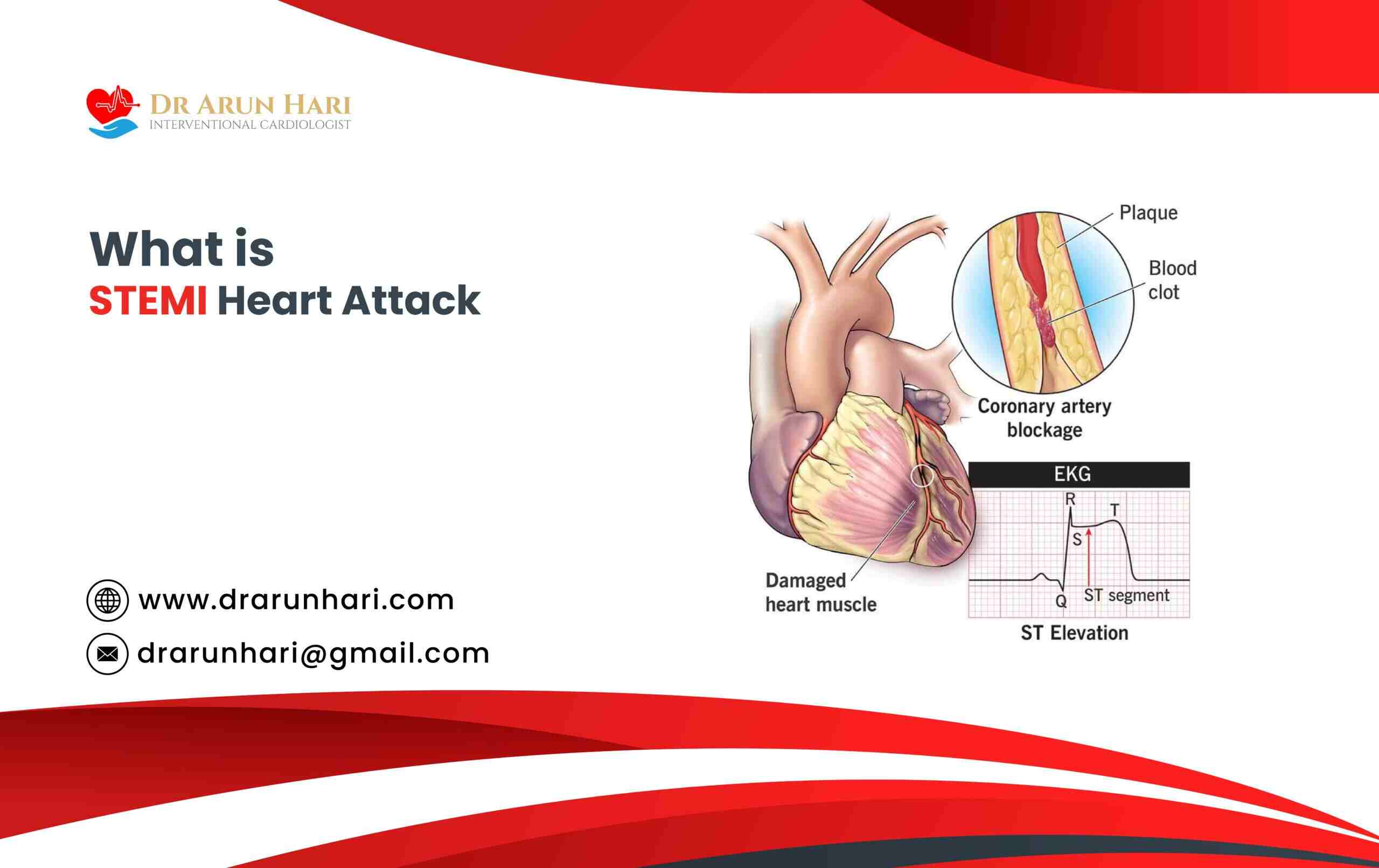 Read more about the article What Is A STEMI Heart Attack?