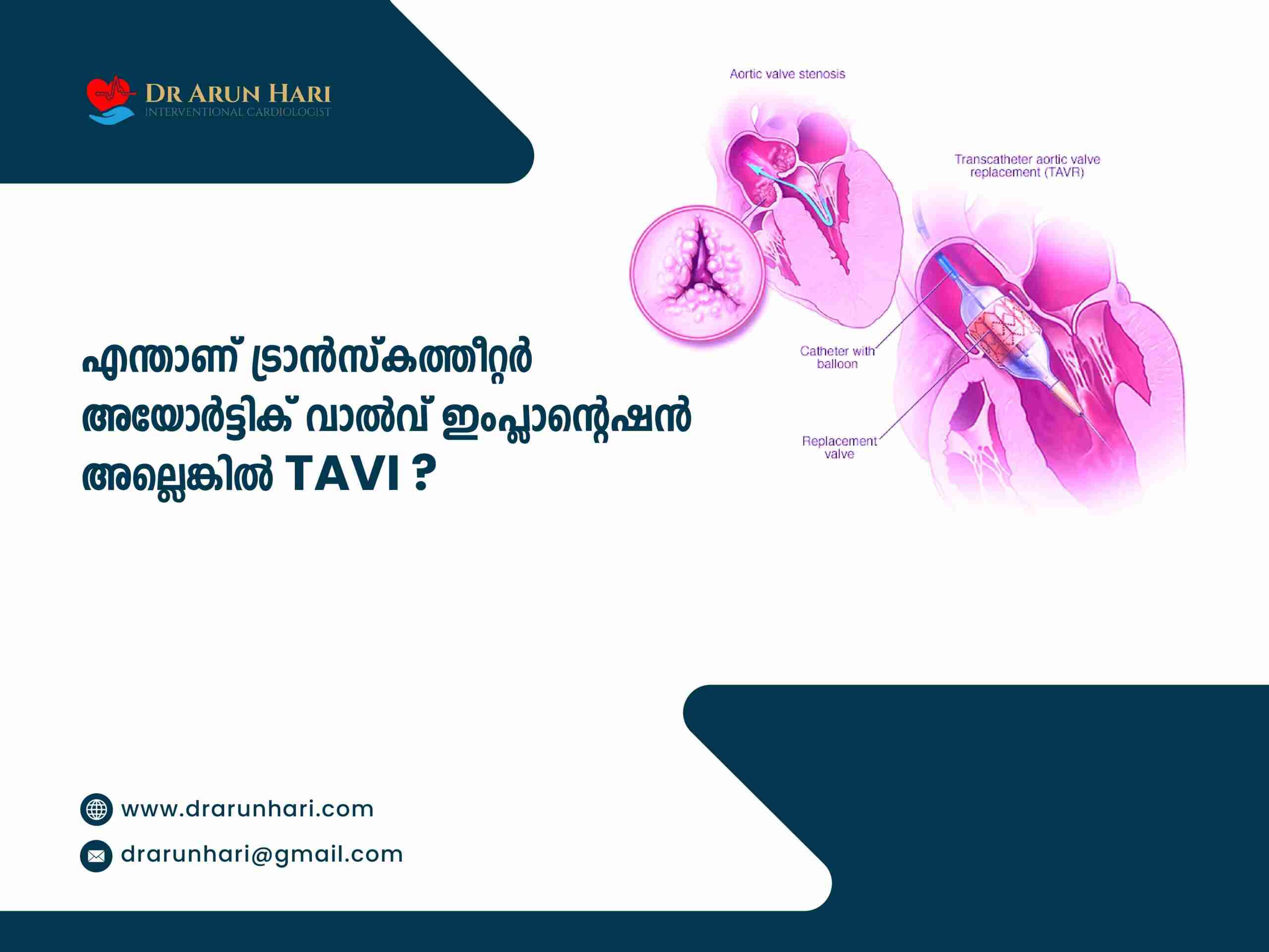 You are currently viewing എന്താണ് ട്രാൻസ്‌കത്തീറ്റർ അയോർട്ടിക് വാൽവ് ഇംപ്ലാന്റേഷൻ അല്ലെങ്കിൽ TAVI?