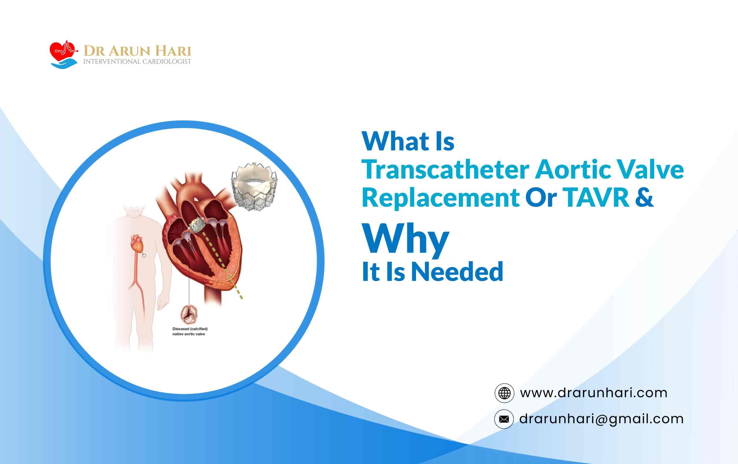 Read more about the article What Is Transcatheter Aortic Valve Implantation Or TAVI?