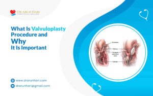 Read more about the article What Is Valvuloplasty Procedure & Why It Is Important?