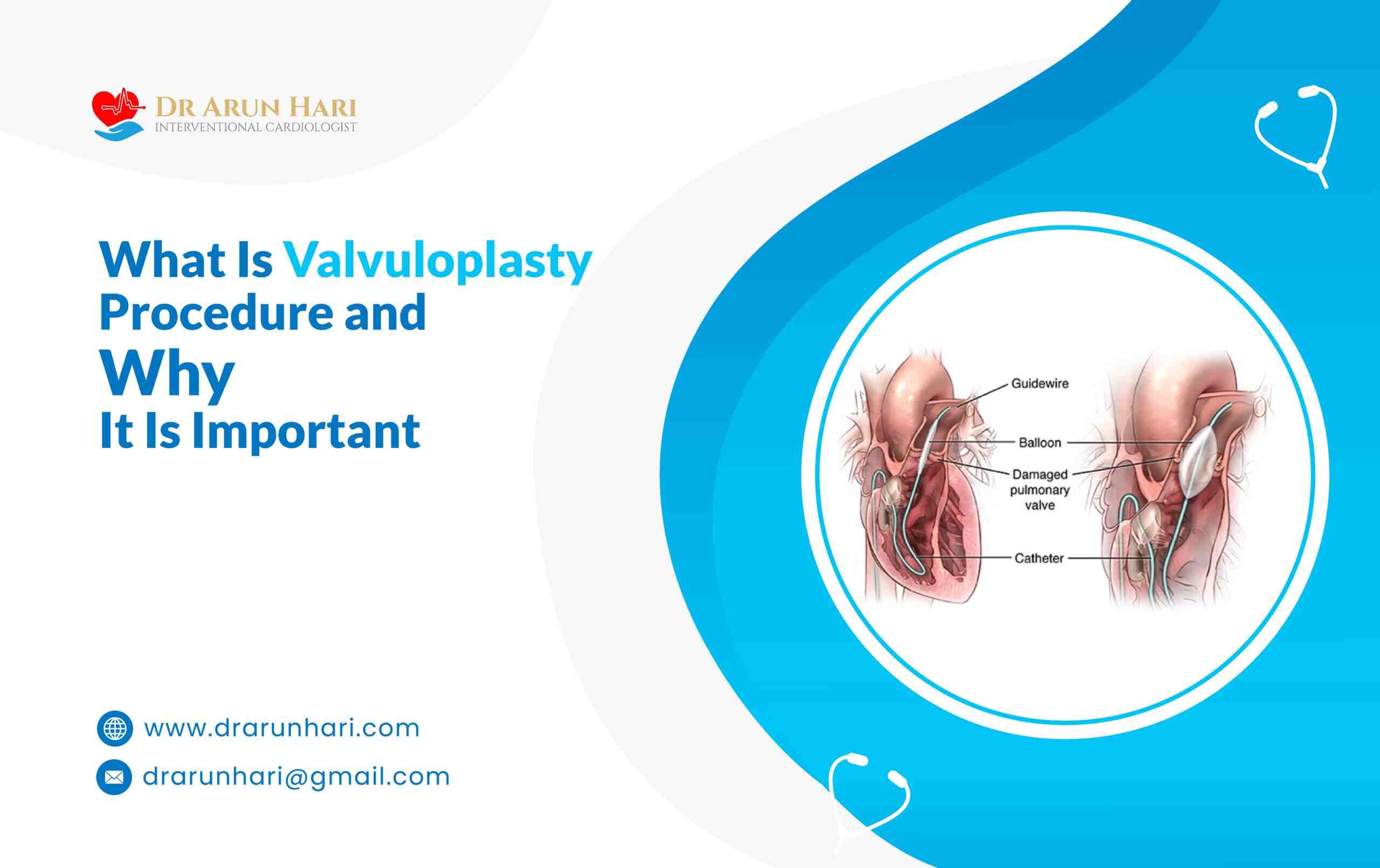 You are currently viewing What Is Valvuloplasty Procedure & Why It Is Important?