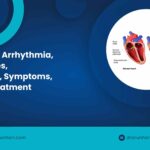 Arrhythmia, Its Types, Causes, Symptoms, & Treatment