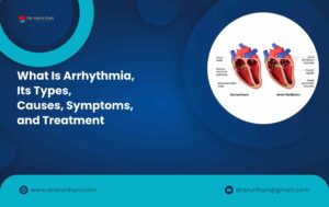 Read more about the article Arrhythmia, Its Types, Causes, Symptoms, & Treatment