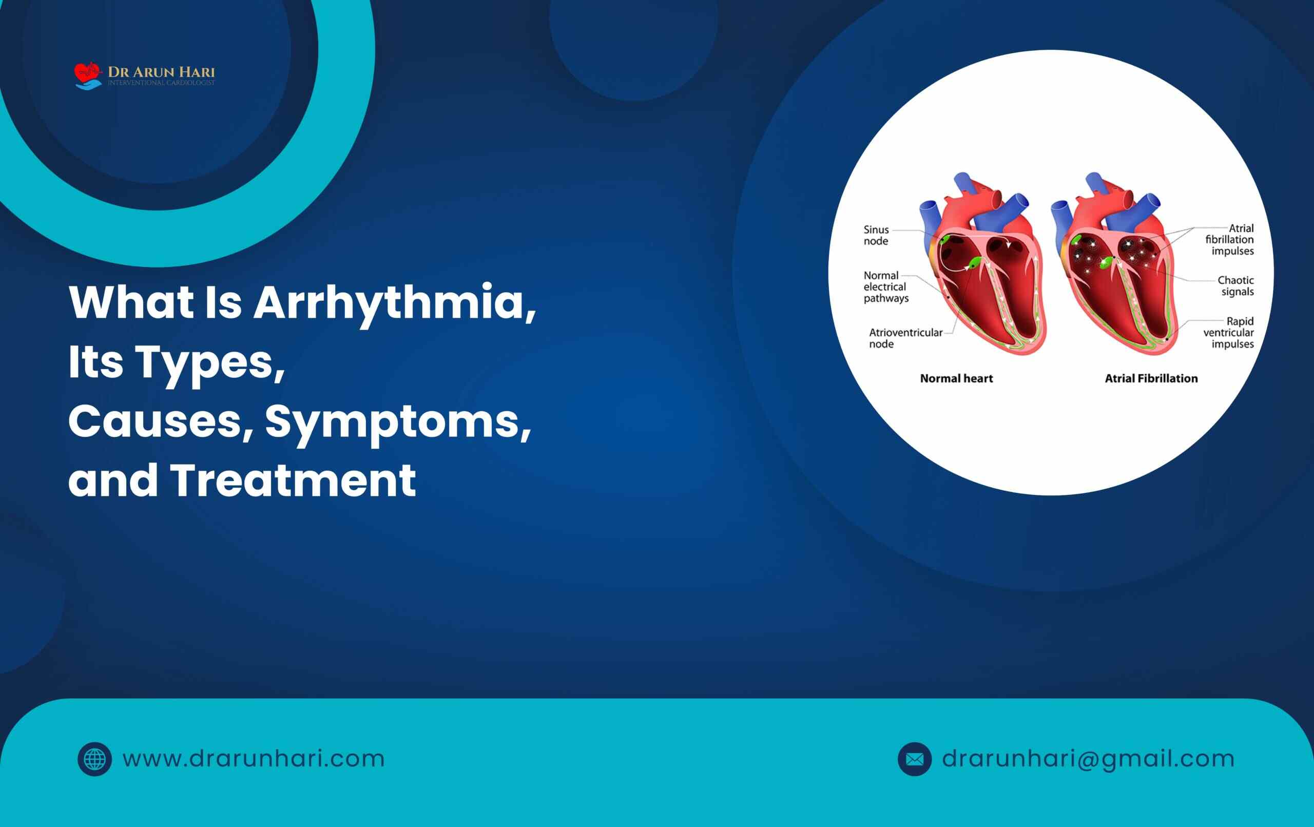 Read more about the article Arrhythmia, Its Types, Causes, Symptoms, & Treatment