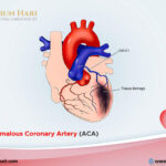 All about Anomalous Coronary Artery (ACA)