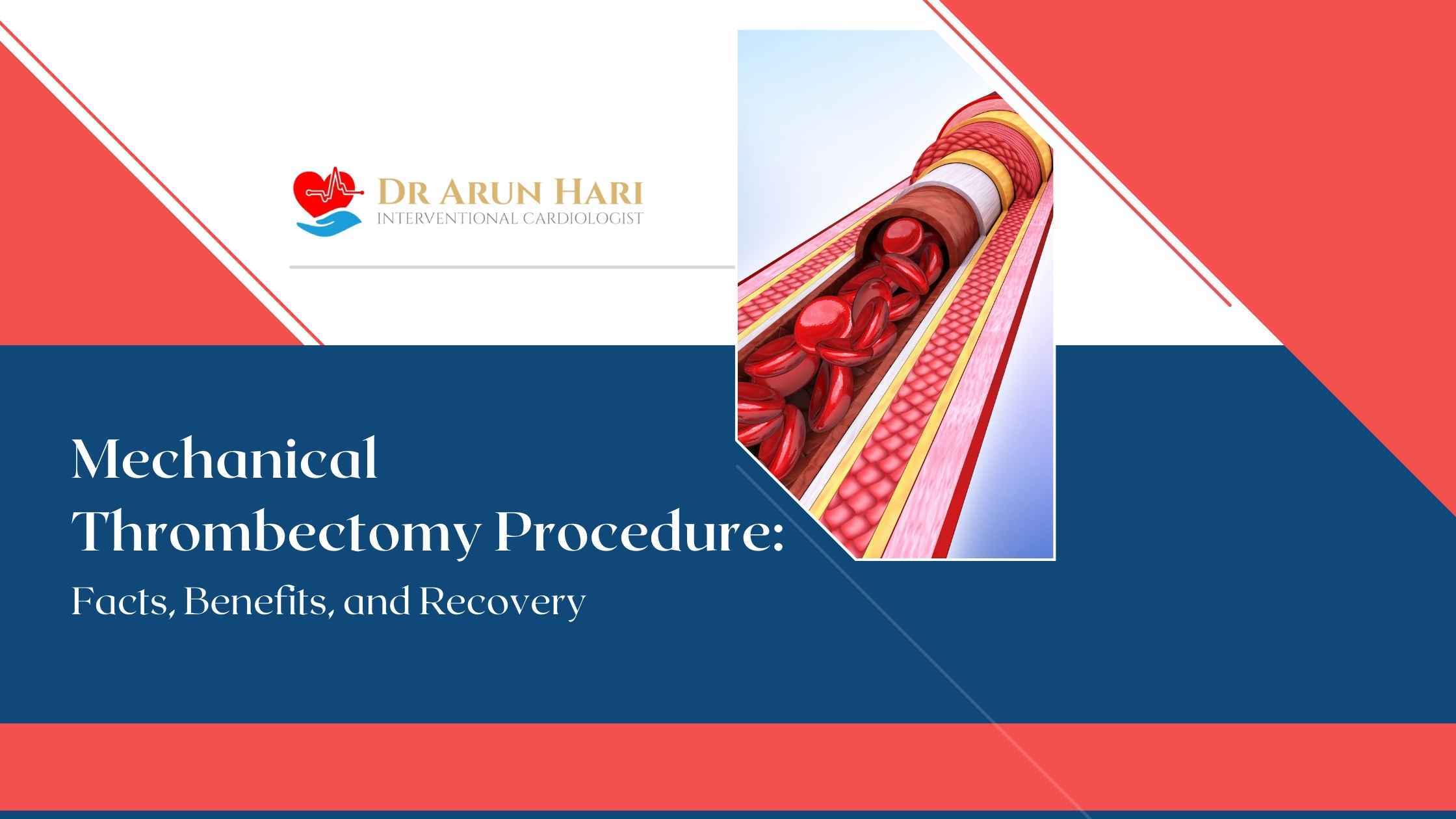 Read more about the article Mechanical Thrombectomy Procedure: Minimally Invasive Stroke Treatment and Clot Removal