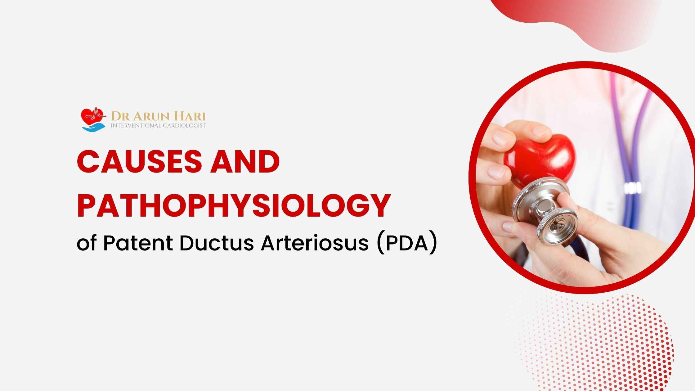 You are currently viewing Causes and Pathophysiology of Patent Ductus Arteriosus (PDA)