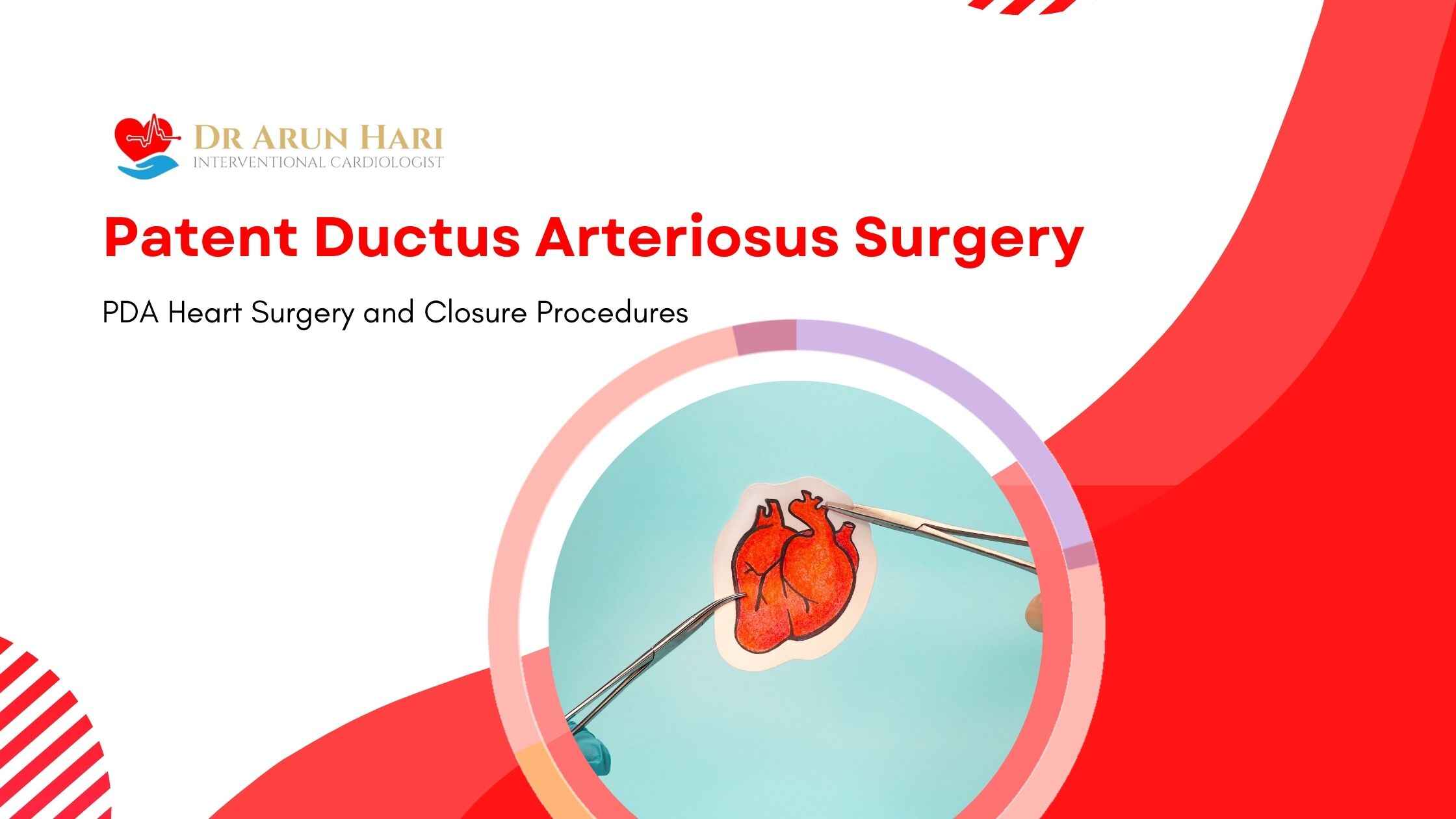 You are currently viewing Patent Ductus Arteriosus Surgery – PDA Heart Surgery and Closure Procedures